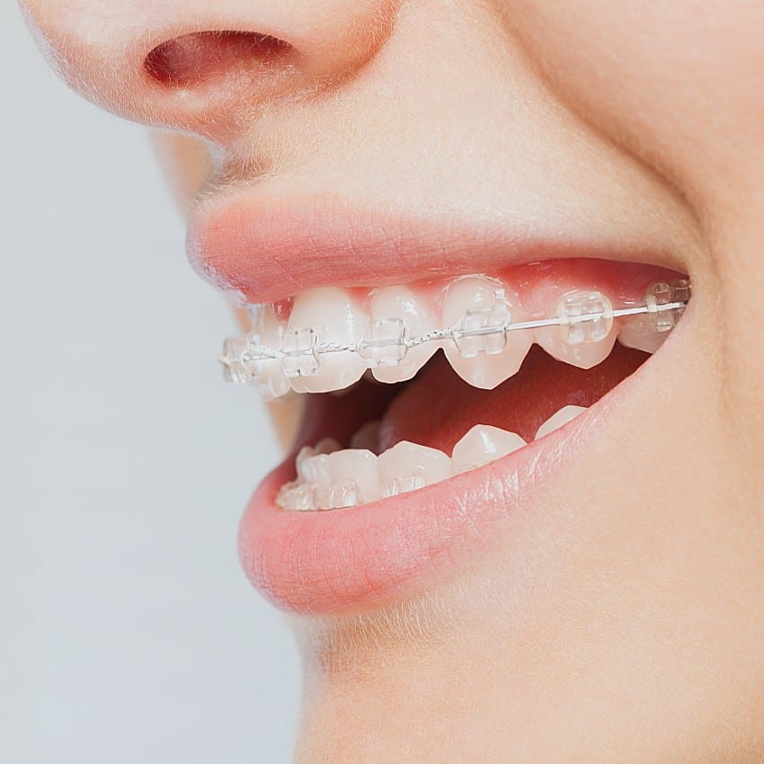 How To Choose The Right Braces In Littleton For A Perfect Smile