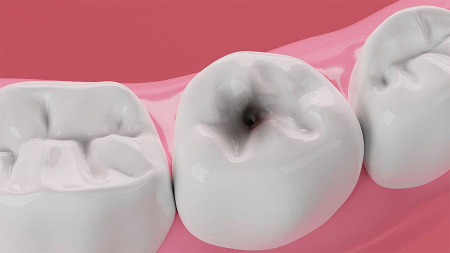 Cavity Prevention Strategies For The Whole Family