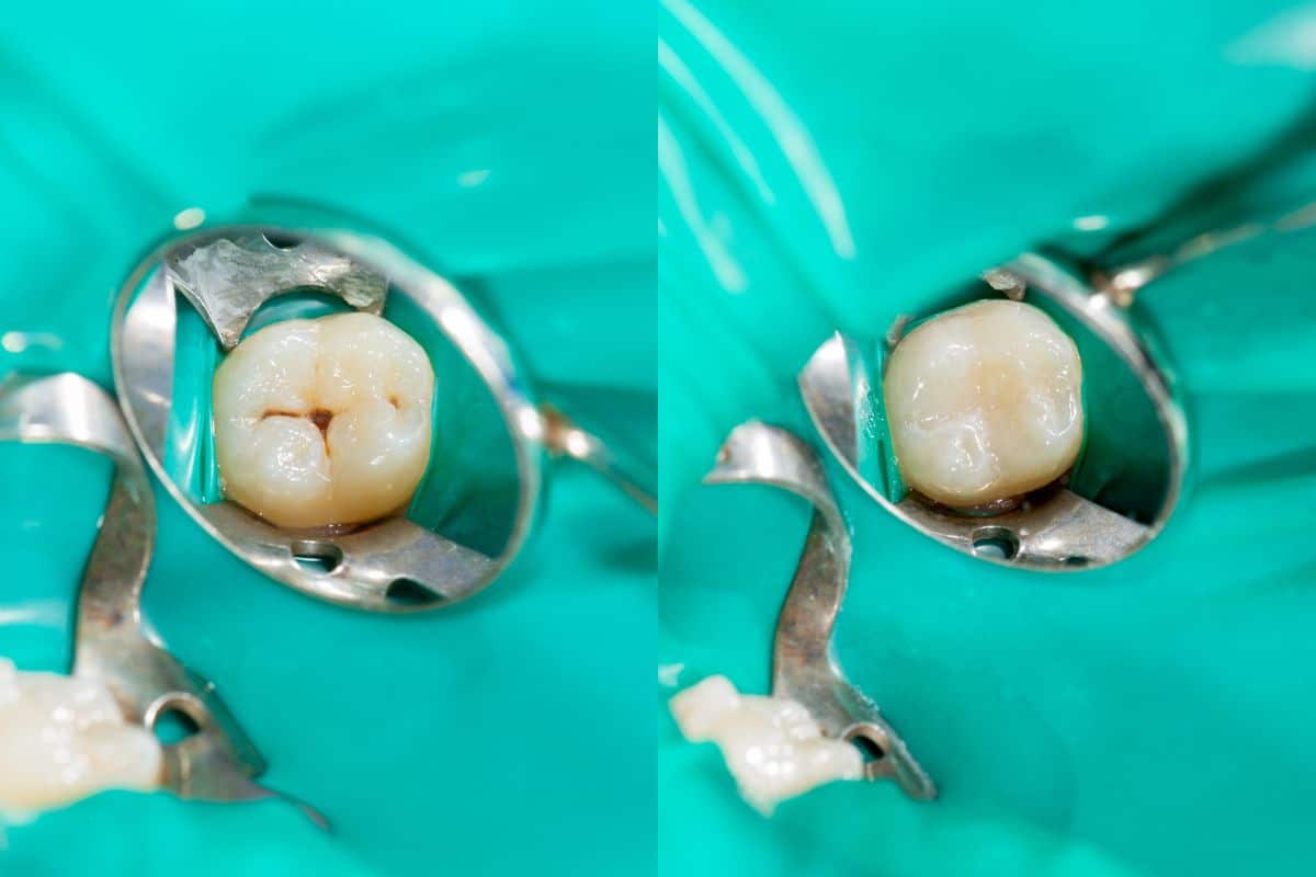 The Benefits Of Fluoride And Sealants In General Dentistry