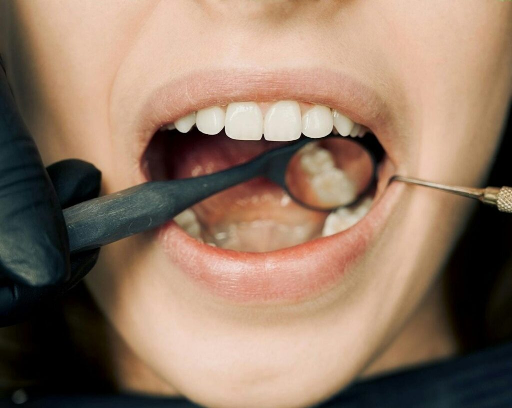 Dental Fillings, Cleanings, And Exams: General Care Explained