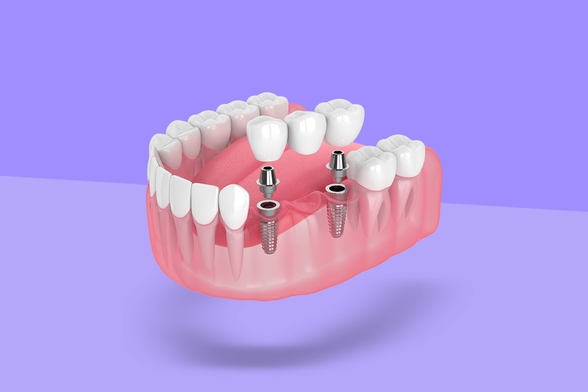 4 Innovations Transforming Implant Dentistry In 2025