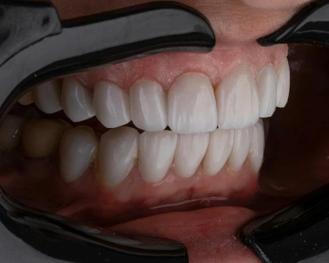 Soft Tissue Grafting For Implants: Restoring Pink Aesthetics