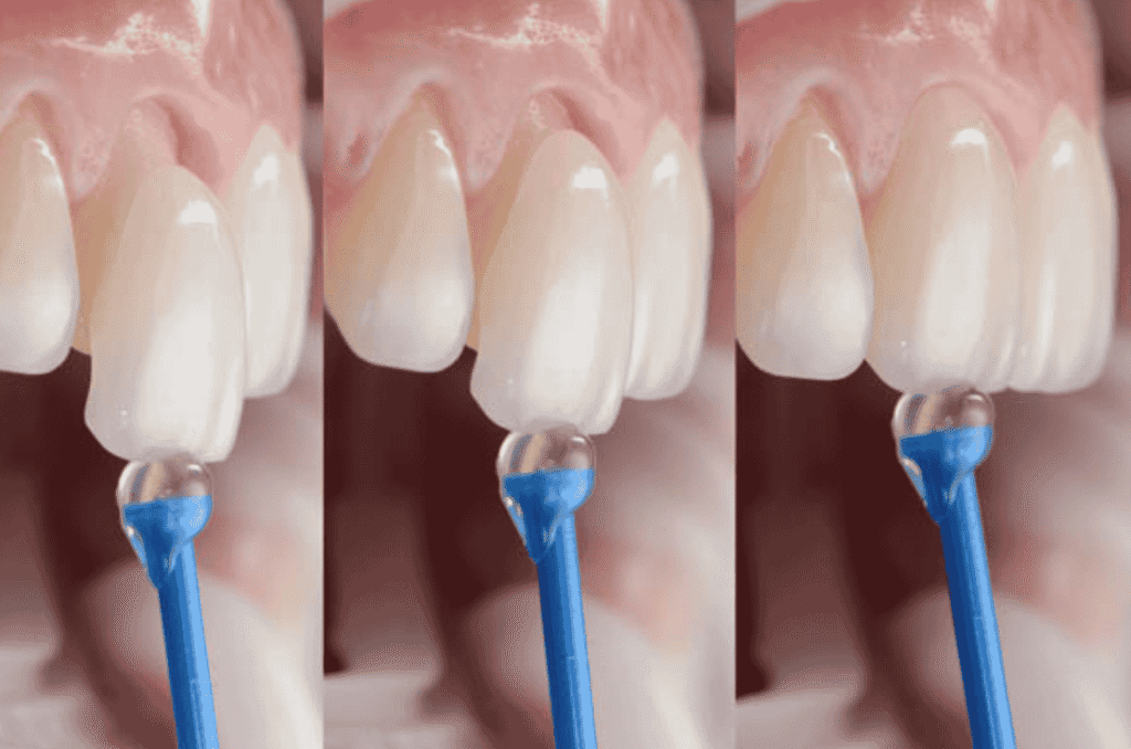 Why Preventive Dentistry Matters Before Whitening, Veneers, Or Bonding