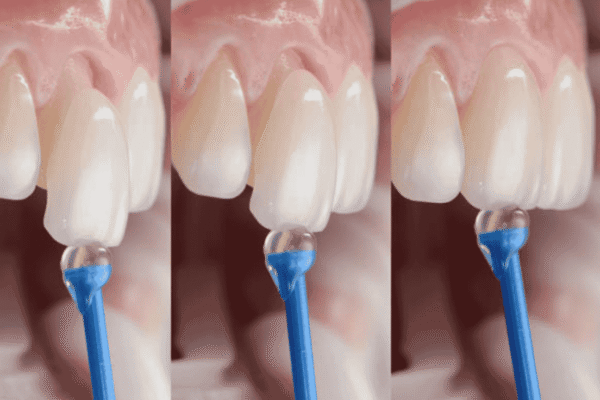 Why Preventive Dentistry Matters Before Whitening, Veneers, Or Bonding