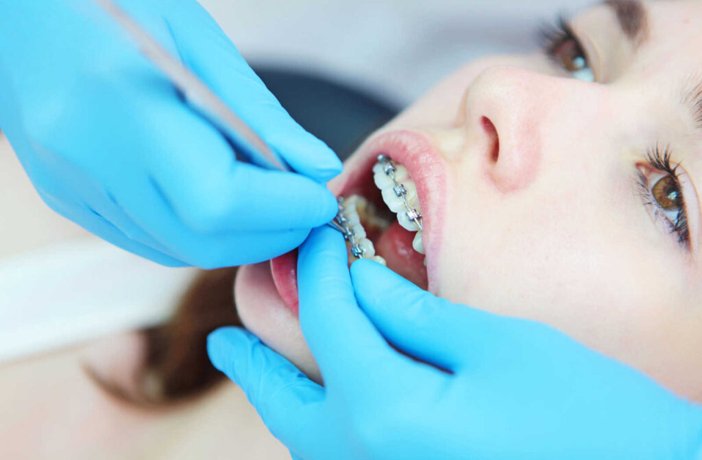 How To Keep Your Teeth Healthy During Orthodontic Treatment