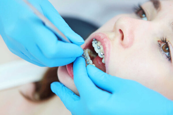How To Keep Your Teeth Healthy During Orthodontic Treatment