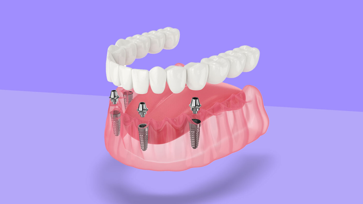 How Implant Dentistry Enhances Both Aesthetics And Function