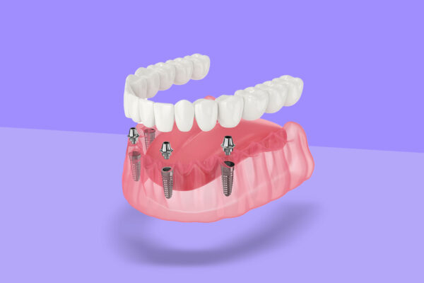 How Implant Dentistry Enhances Both Aesthetics And Function