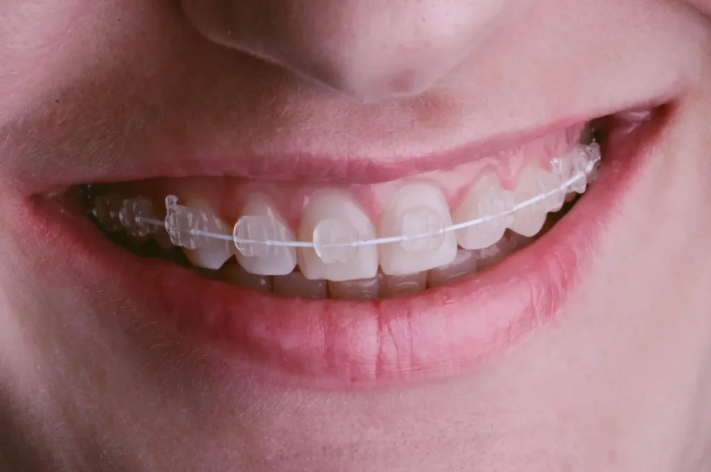 5 Common Orthodontic Treatments Every Patient Should Know