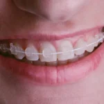 Orthodontic Treatments