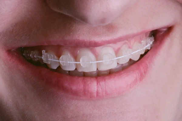 5 Common Orthodontic Treatments Every Patient Should Know