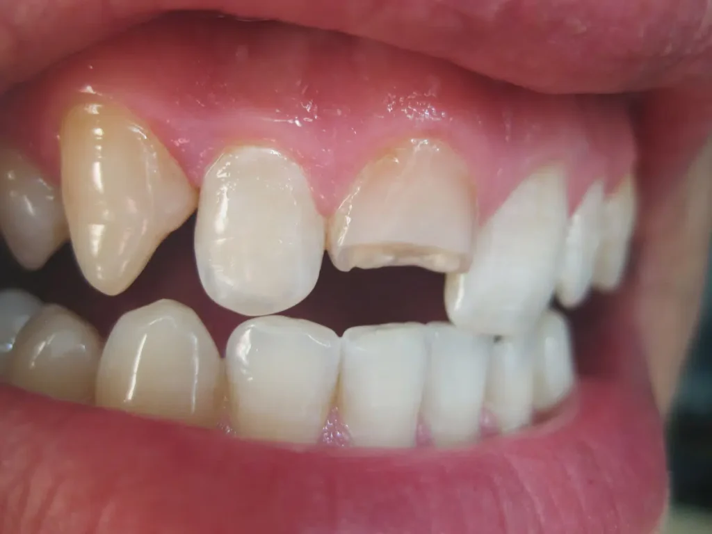 Handling A Cracked Tooth Before Seeing The Dentist
