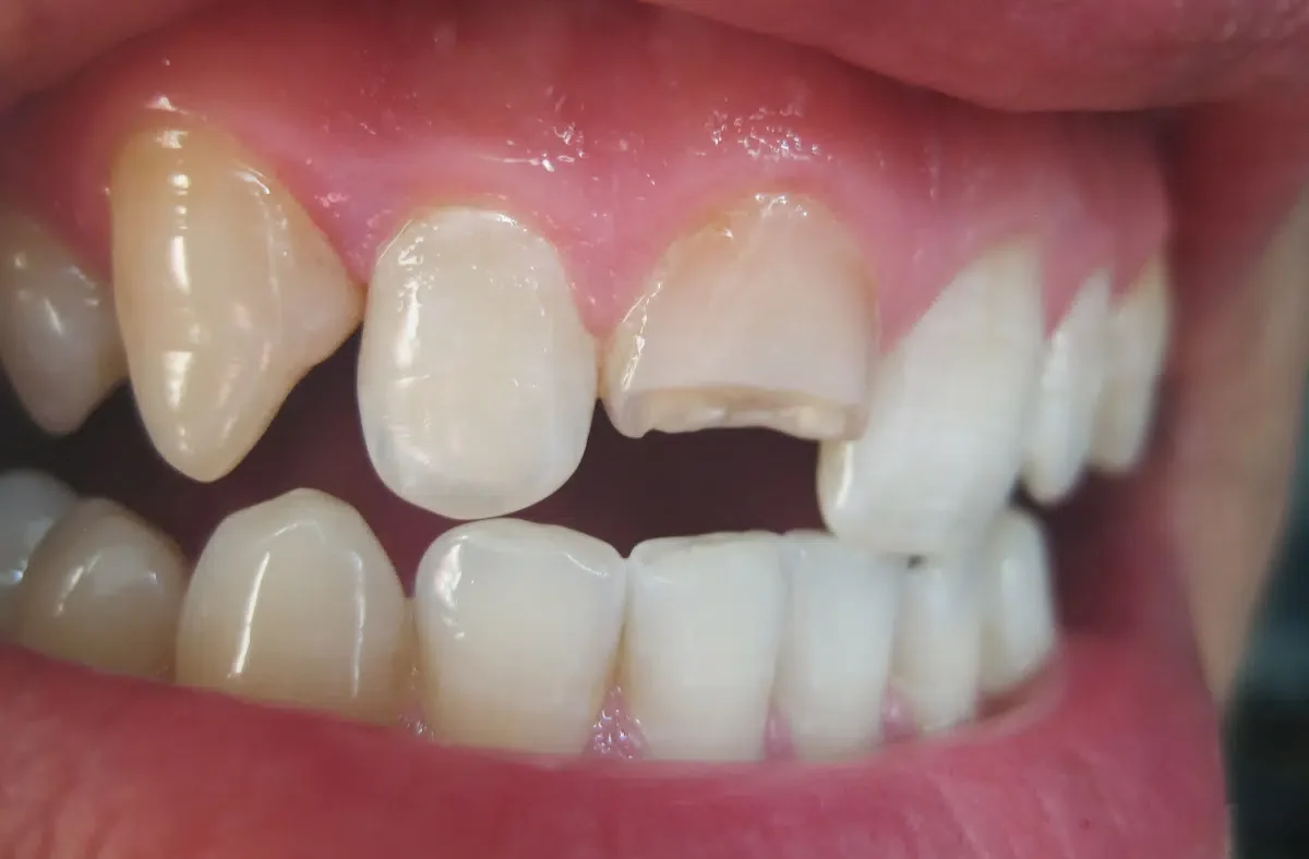 Handling A Cracked Tooth Before Seeing The Dentist