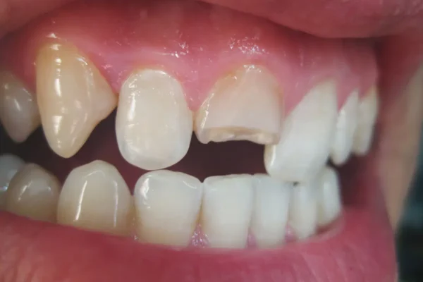 Handling A Cracked Tooth Before Seeing The Dentist