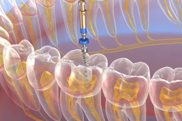 4 Signs A Tooth May Need Endodontic Intervention
