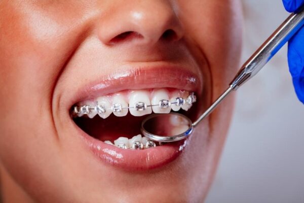 5 Reasons Regular Adjustments Are Key To Orthodontic Success