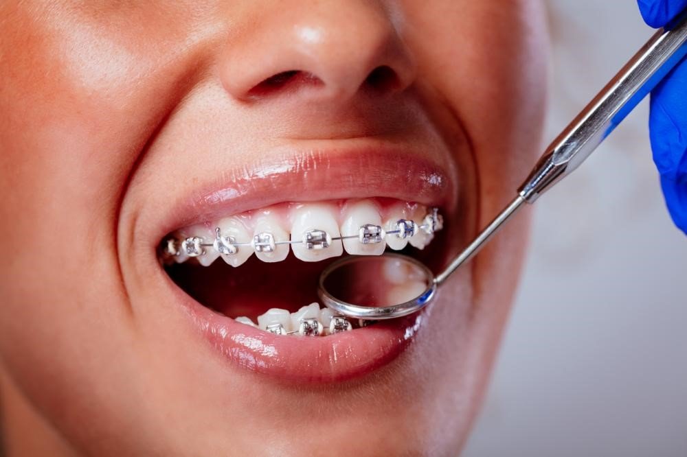5 Reasons Regular Adjustments Are Key To Orthodontic Success