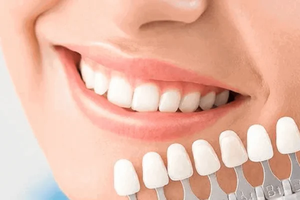 4 Popular Cosmetic Treatments Provided by General Dentists