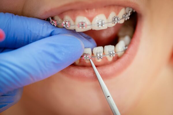 5 Ways General Dentistry Supports Orthodontic Success