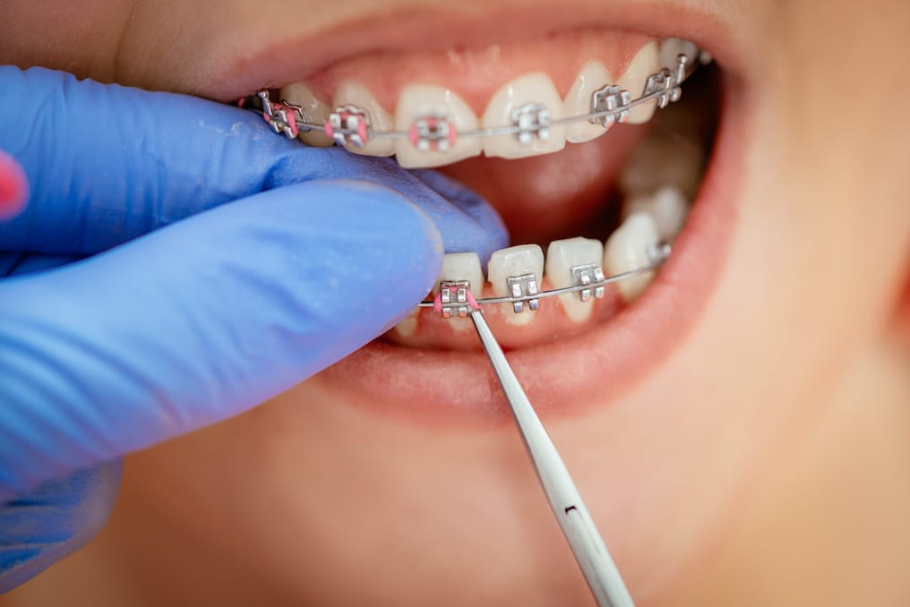 5 Ways General Dentistry Supports Orthodontic Success